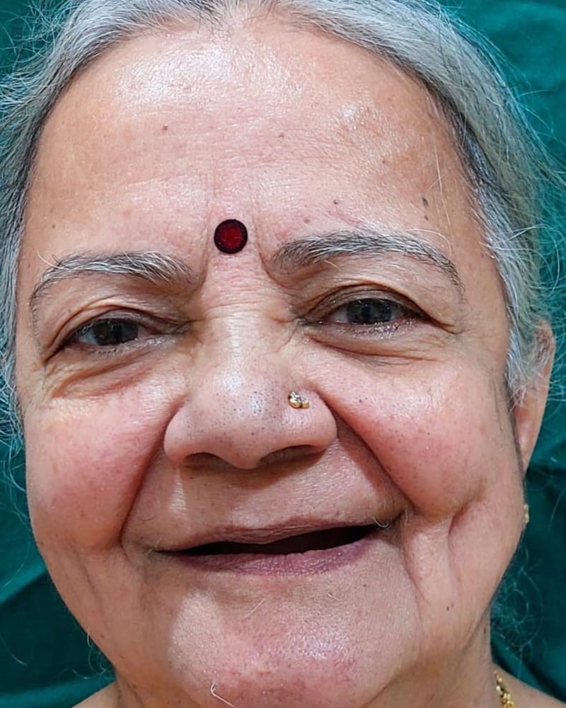 Before treatment at Jayanagar Dental Clinic