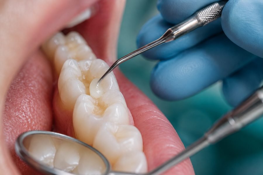 Tooth-Coloured Fillings
