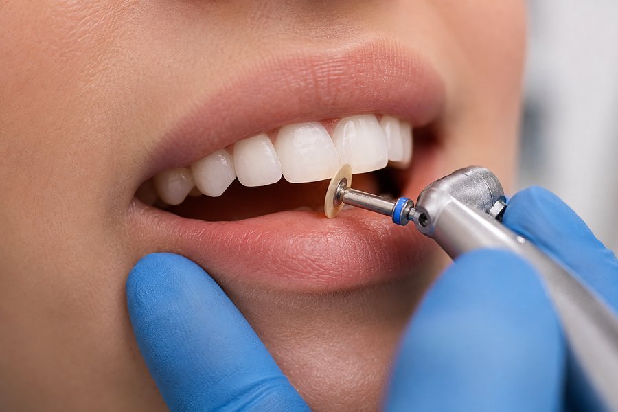 Tooth Reshaping