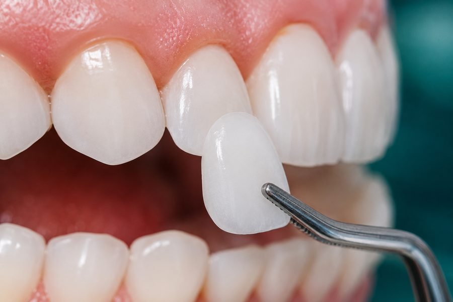 Dental Veneers
