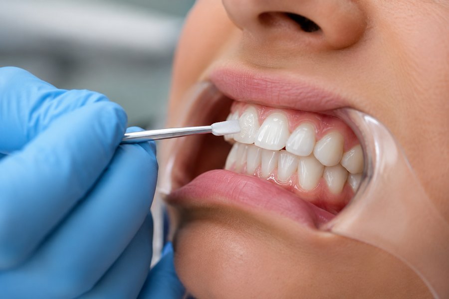 Teeth Whitening