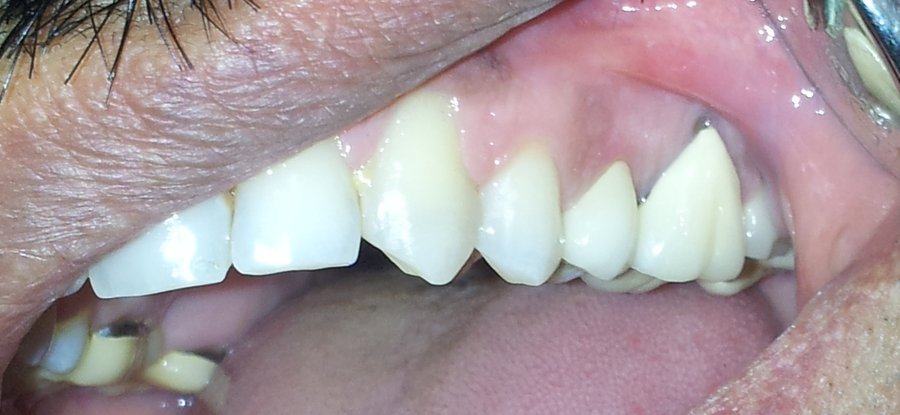 Zirconia Crown Restoration &mdash; after treatment at Jayanagar Dental Clinic