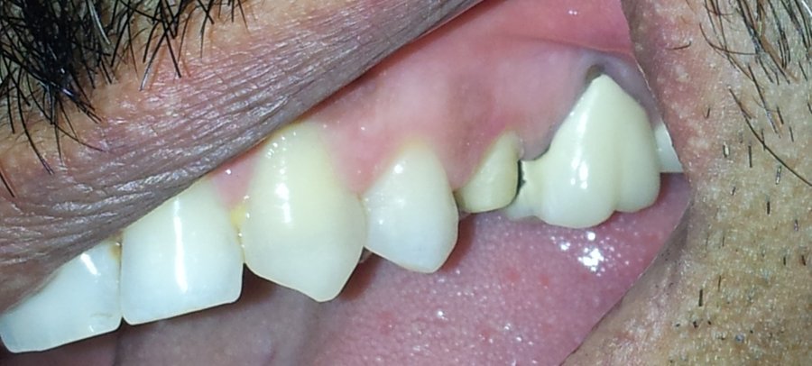 Zirconia Crown Restoration &mdash; before treatment at Jayanagar Dental Clinic