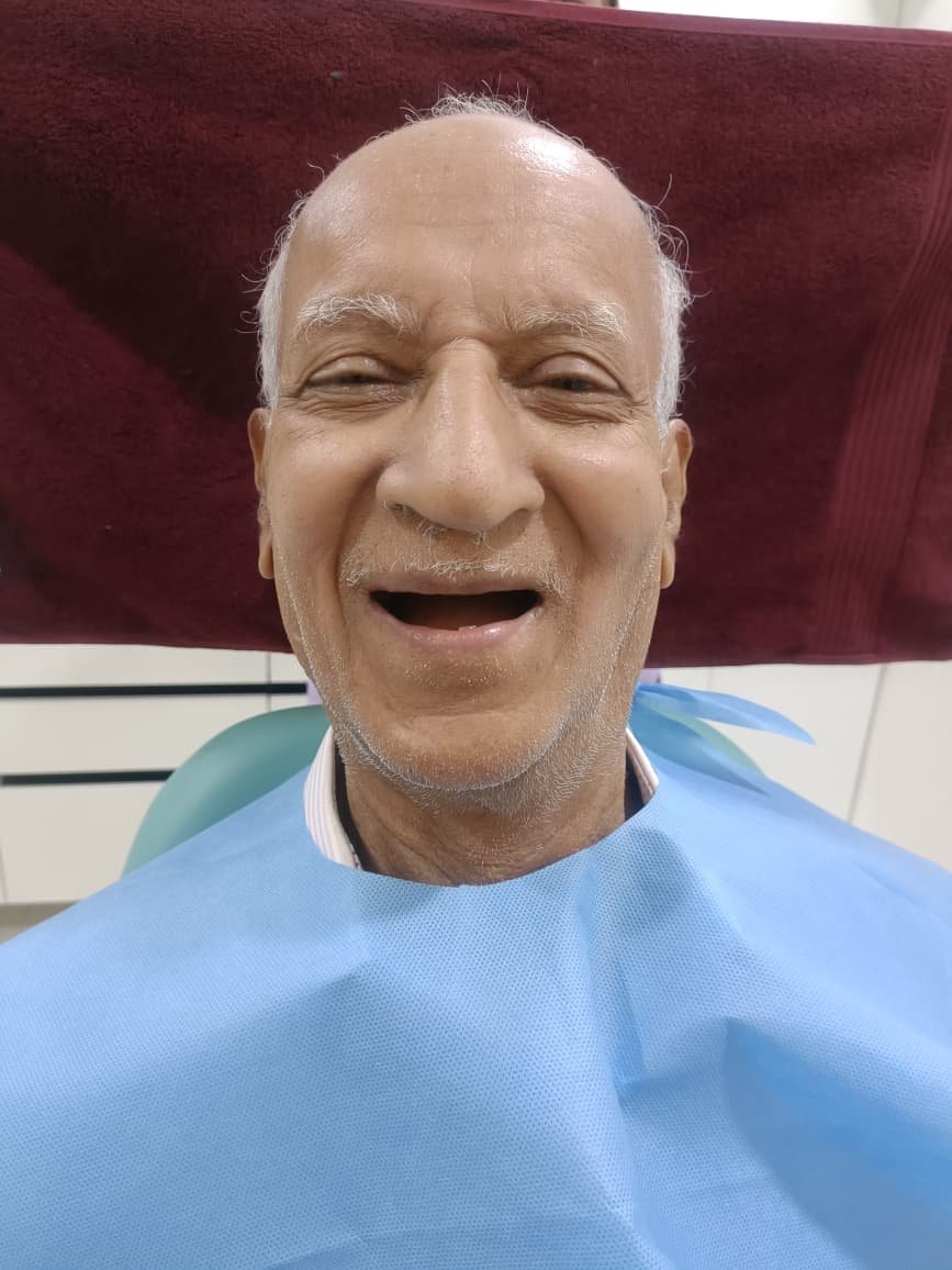 Complete Denture Rehabilitation &mdash; before treatment at Jayanagar Dental Clinic