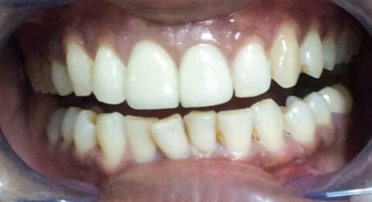 Management of Discoloured Teeth &mdash; all-ceramic crowns at Jayanagar Dental Clinic
