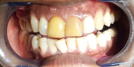 Management of Discoloured Teeth &mdash; before treatment at Jayanagar Dental Clinic