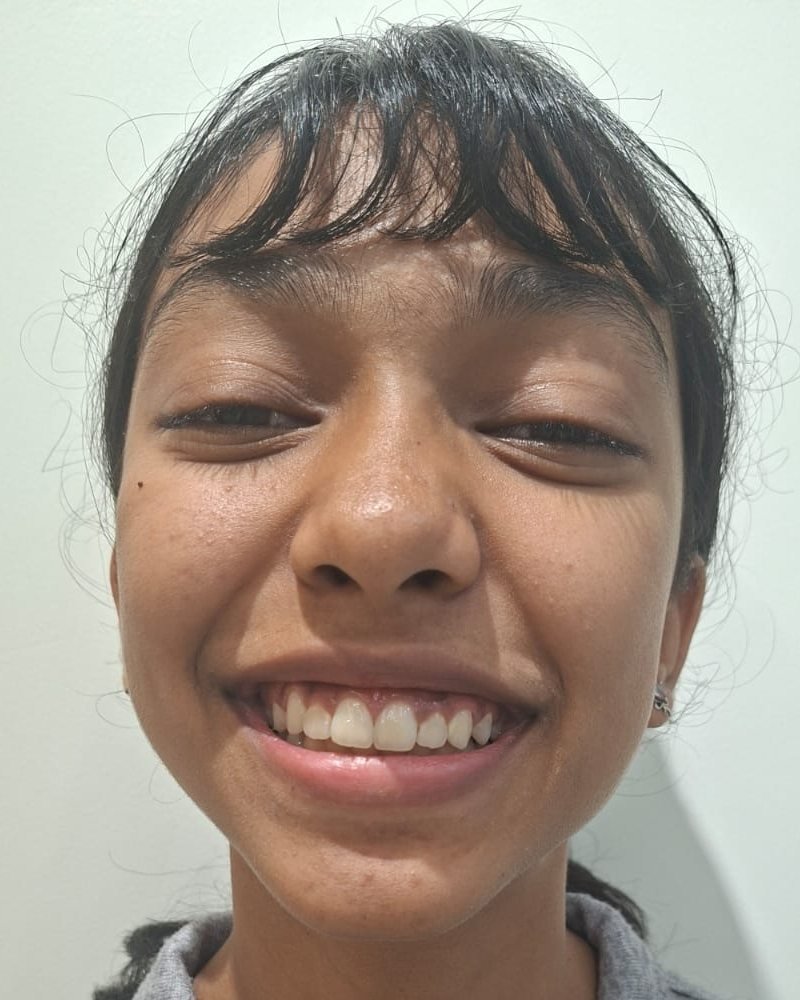 Orthodontic Alignment &mdash; after treatment at Jayanagar Dental Clinic