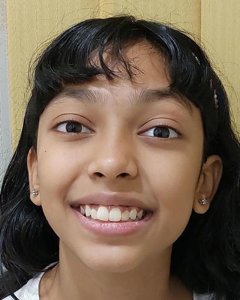 Orthodontic Alignment &mdash; before treatment at Jayanagar Dental Clinic