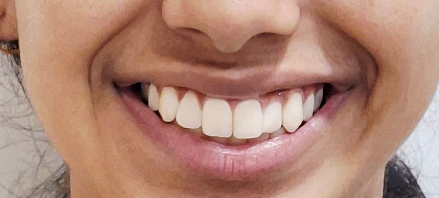 Evenly aligned upper front teeth &mdash; after orthodontic treatment at Jayanagar Dental Clinic
