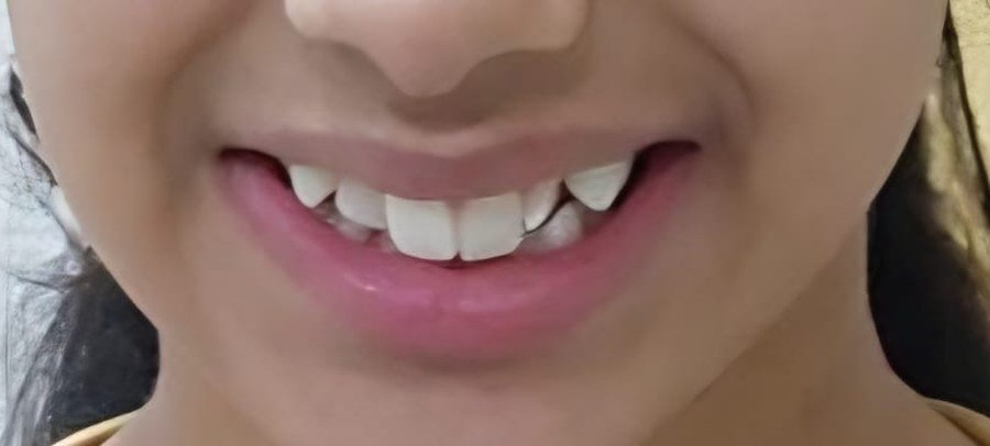 Crowded and protruding upper front teeth &mdash; before orthodontic treatment at Jayanagar Dental Clinic