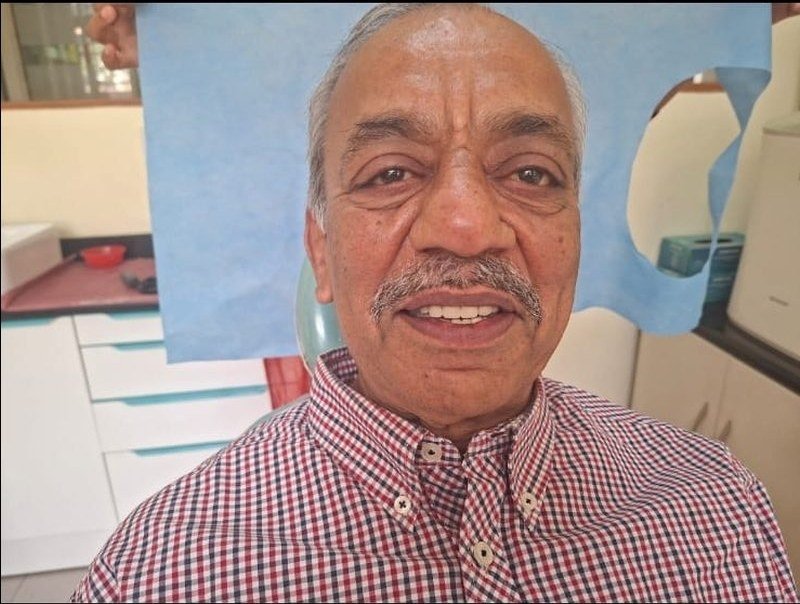 Removable Partial Denture Prosthesis &mdash; after treatment at Jayanagar Dental Clinic