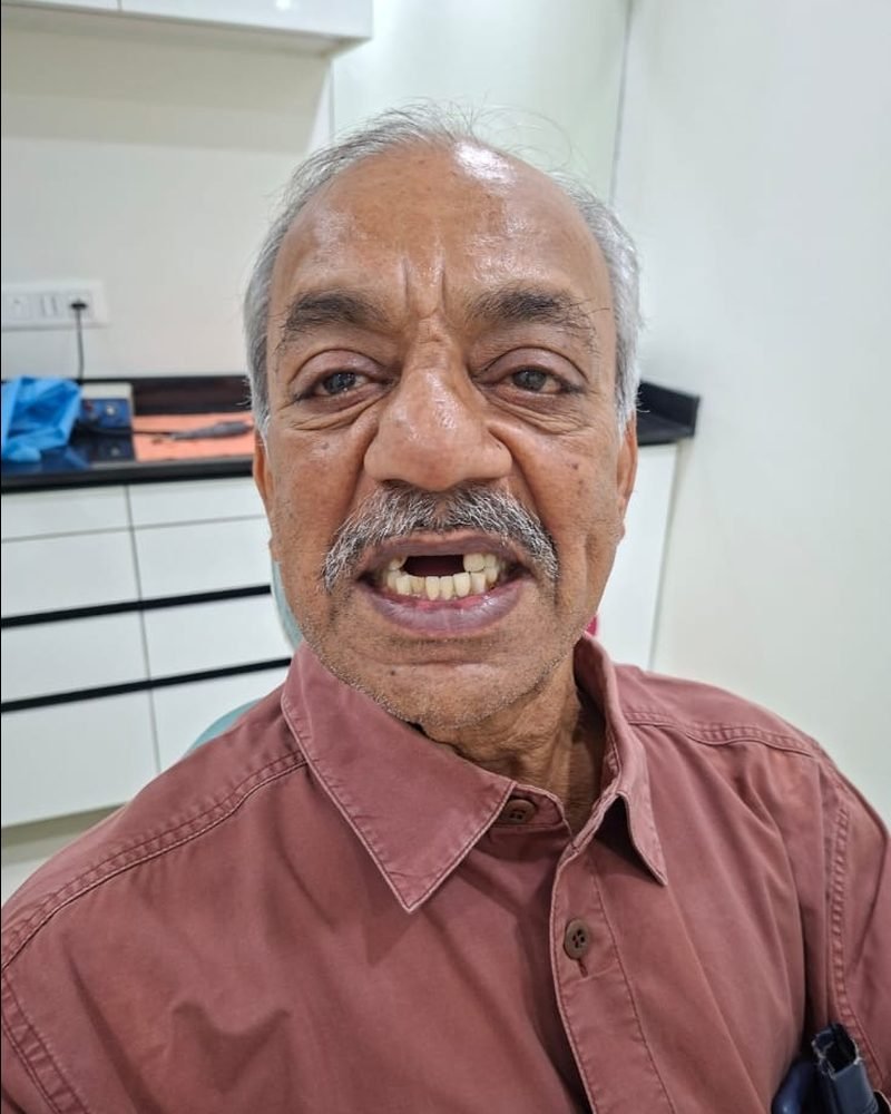 Removable Partial Denture Prosthesis &mdash; before treatment at Jayanagar Dental Clinic