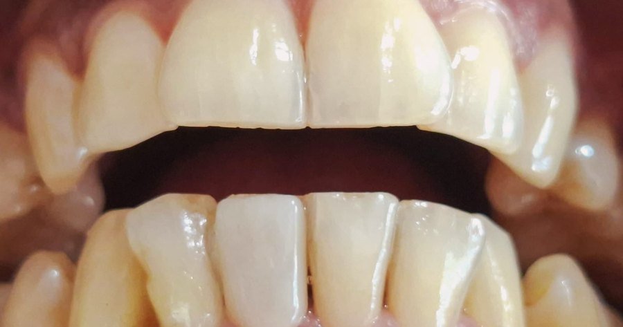 Even, natural-looking lower front teeth restored with ceramic veneers at Jayanagar Dental Clinic