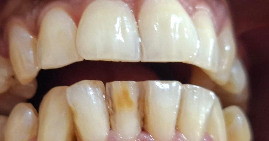 Worn, chipped and heavily stained lower front teeth &mdash; before ceramic veneers at Jayanagar Dental Clinic