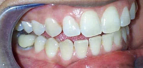 Teeth Whitening &mdash; after treatment at Jayanagar Dental Clinic