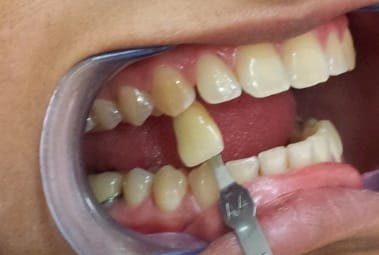 Teeth Whitening &mdash; before treatment at Jayanagar Dental Clinic