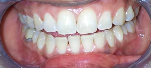 Teeth Whitening &mdash; after treatment at Jayanagar Dental Clinic