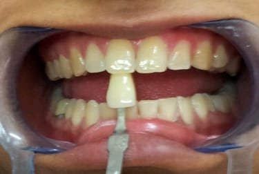 Teeth Whitening &mdash; before treatment at Jayanagar Dental Clinic